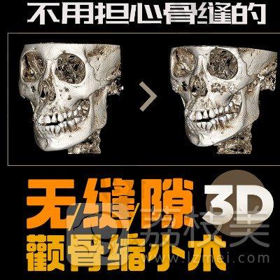 韩国美迪莹3D颧骨缩小术，让你CT图上看效果