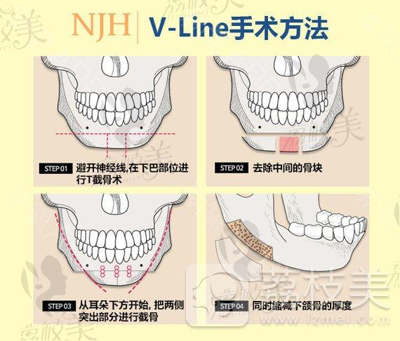 韩国NJH卢钟勋整形，这什么神仙轮廓术式，让人真正脱胎换