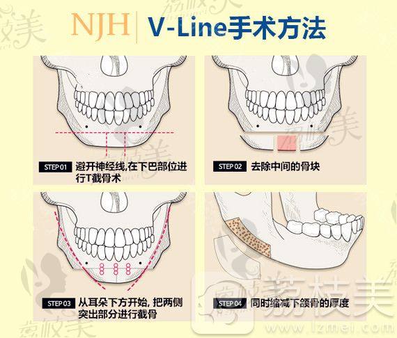 V-LINE手术方式