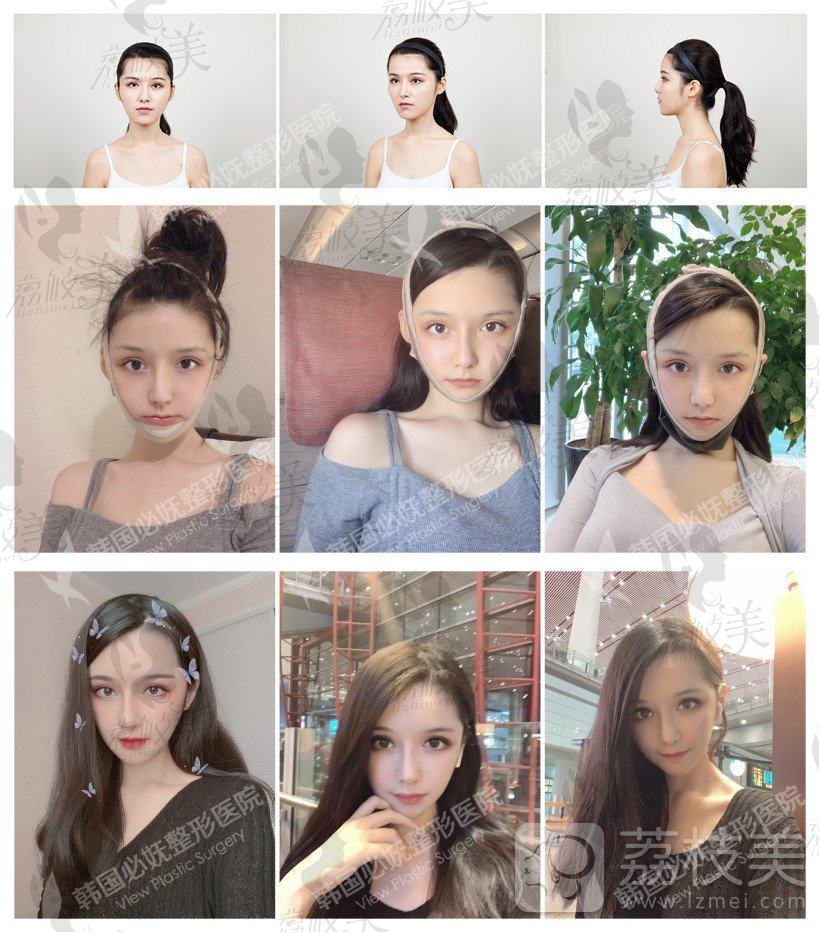 韩国必妩V-LINE瓜子脸轮廓7件套5W，打造明星般 骨相脸