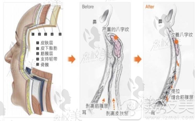 清潭FIRST小切口从筋膜层提升