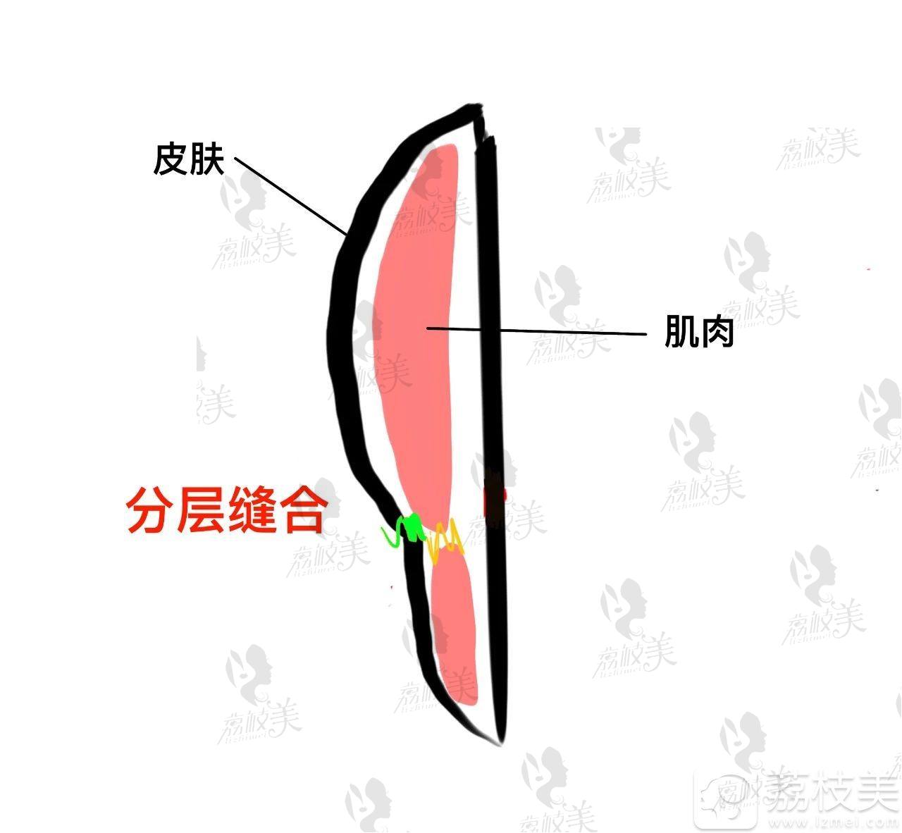 双眼皮肉条感如何修复