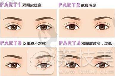 双眼皮手术失败常见的类型