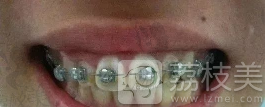 骨性龅牙牙齿矫正上颌牙套佩戴