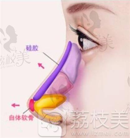 硅胶隆鼻