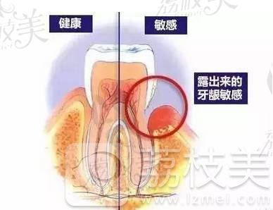 牙龈敏感