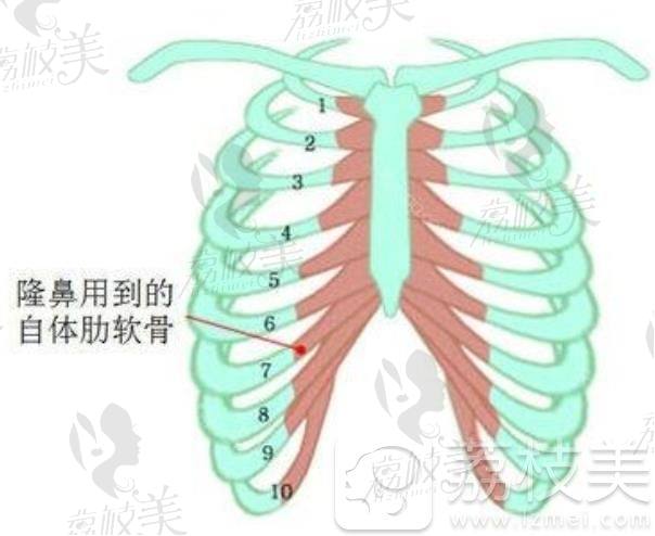 肋软骨隆鼻