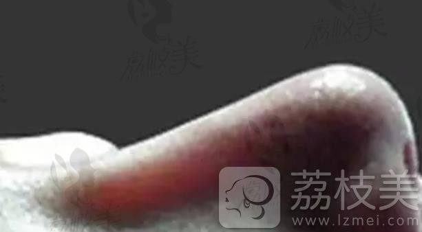 鼻子透光