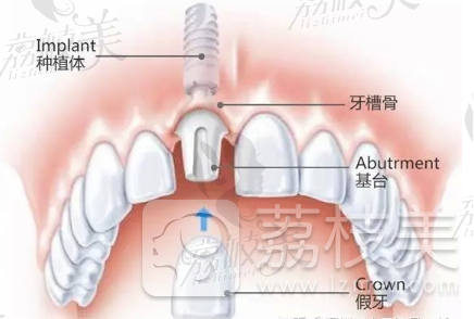 长沙美奥口腔：种植牙为什么具有安全性