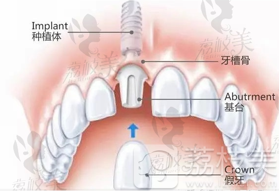 長沙美奧口腔醫(yī)院種植牙價格公布2025