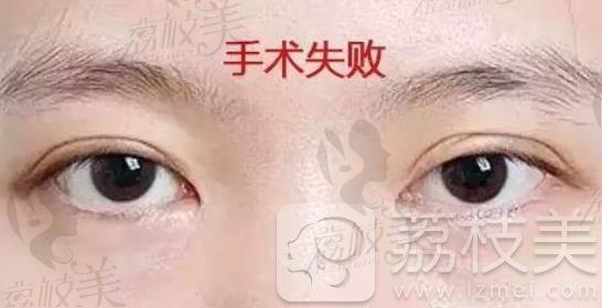 雙眼皮割失敗