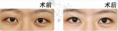 双眼皮手术效果不明显