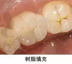 泰州玲瓏口腔門診部全瓷牙 泰州玲瓏口腔門診部全瓷牙