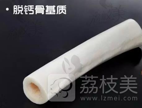 异体骨是什么？鼻综合整形用异体骨好不好？会感染吗？