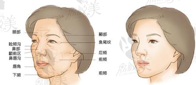 面部填充后你可能需要一个漂亮的眉弓？