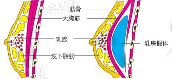 关于隆胸，这里有你