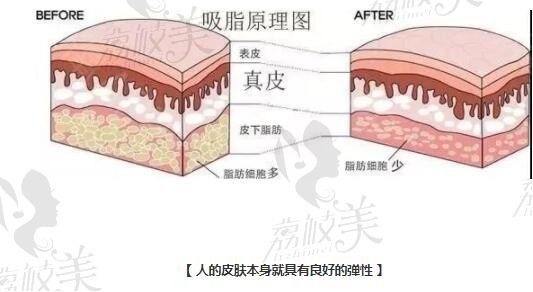 听说吸脂会导致皮肤松弛？对不起，吸脂不背这个锅！