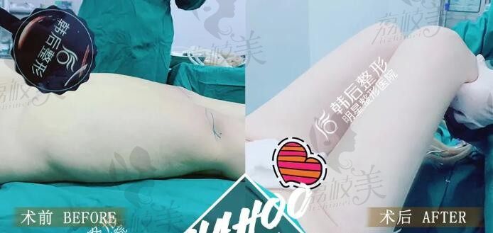 找广州韩后整形姜政辉进行大腿吸脂塑后大象腿变腿精