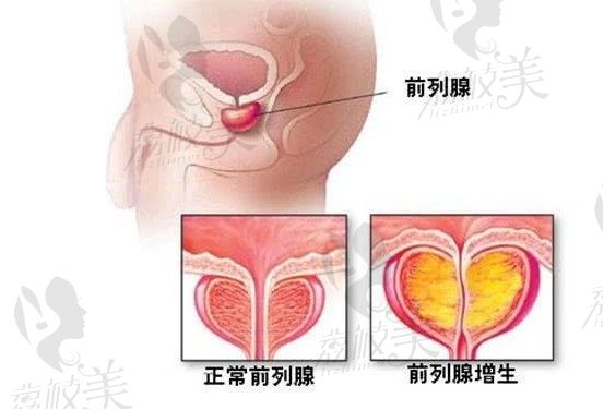 韩国世檀塔金道理院长告诉你生活习惯”如何影响“前列腺增生