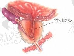 韩国世檀塔金道理告诉你前列腺炎反反复复，能不能根治
