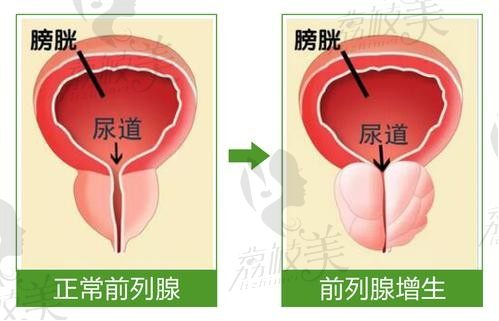 韩国世檀塔男科医院申丞济院长告诉你治疗前列腺增生误区