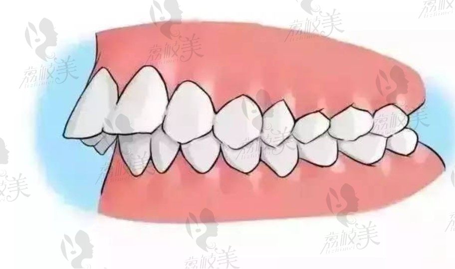 深圳吉华登特口腔门诊部覃杰解答龅牙会遗传吗?如何矫正?