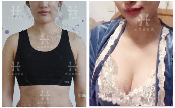 在北京禾美嘉任学会做了真C自体活力丰胸术后1到2个月效果