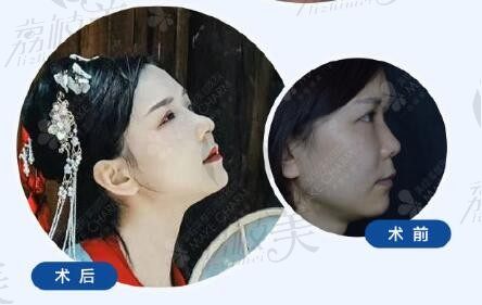 成都美绽美杨平院长使用耳软骨隆鼻等7项专利，让我面部不在凹陷拥有漂亮的主播鼻