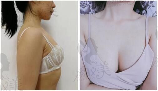北京凯润婷找白晋博士做CRT胶原蛋白丰胸手术两个月效果