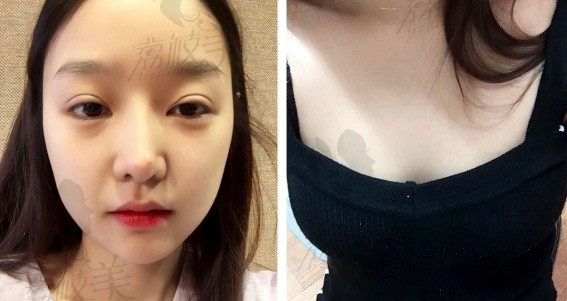 手术前