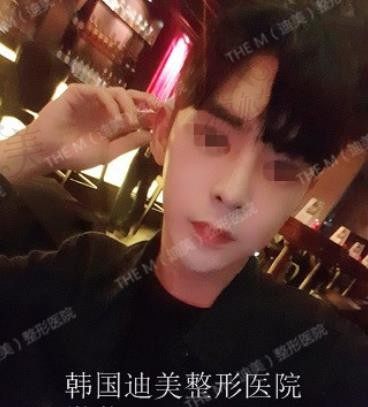 韩国美佳（迪美）李柱洪医师V-Loc埋线手术惊人效果