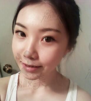 韩国Barbie Face整形姜永浩面部轮廓改变四方脸