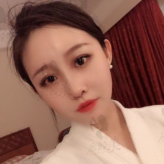 上海华美谢卫国隆鼻怎么样，全肋骨还是半肋骨好？
