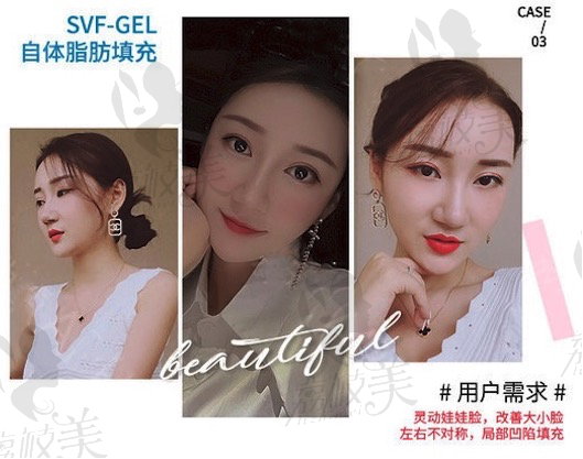 成都天使之翼尤军院长SVF-GEL娃娃脸自体脂肪填充效果怎么样?