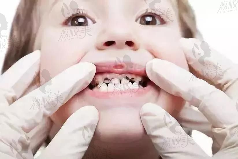 孩子龋齿到底要不要重视？该怎么去预防龋齿？