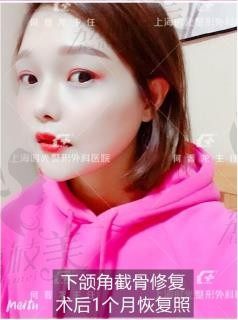 上海时光整形何晋龙院长下颌角去骨修复1个月恢复过程