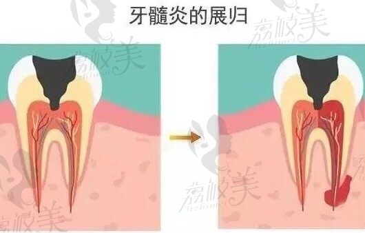 牙髓炎，可以自愈吗?作为一名重度牙髓炎患者的自述。