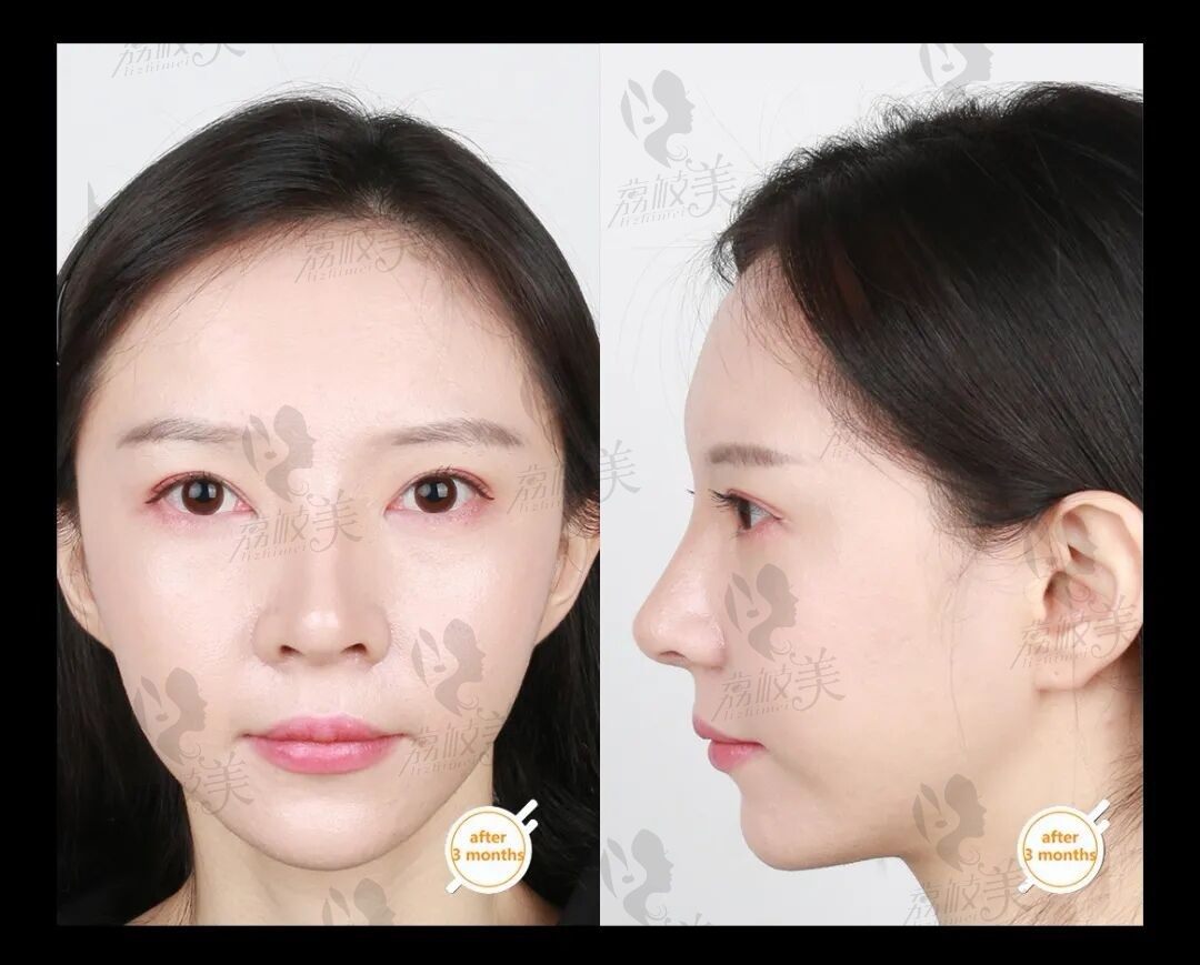 潍坊华美任传琦45度自然天成隆鼻术\修复+超体+肋软骨隆鼻