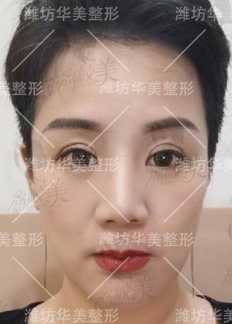 潍坊华美整形五代热玛吉祛皱抵抗老龄化38岁紧致提升回顾30而已