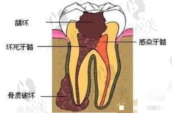 威海德韩牙博仕口腔王淑红说怎么判断补牙还是做根管治疗