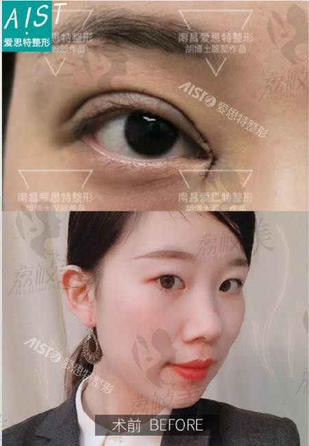 南昌爱思特（艾莱芙）胡秀龙双眼皮案例分享