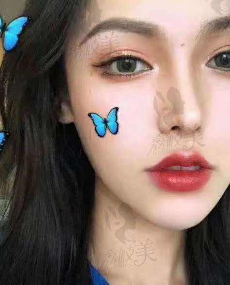 在西安美莱做了微笑唇，变身微笑天使了