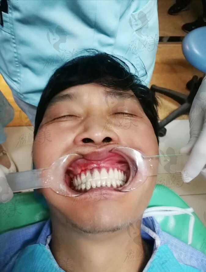 北京雅医家邱星明全口种植牙摆脱缺牙，即刻负重案例分享