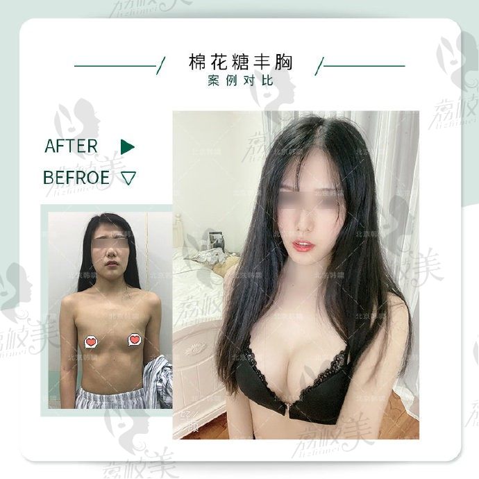 北京韩啸棉花糖隆胸和润美玉之光王明利CGF自体隆胸哪个好