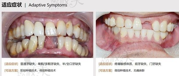 听说广州柏德口腔微创种植牙比较好，是真的吗？