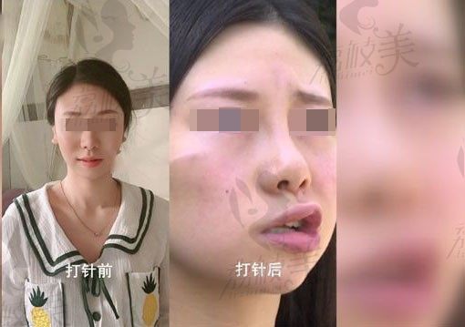 浙江女子打完瘦脸针嘴斜眼歪，科普打瘦脸针脸歪怎么解决