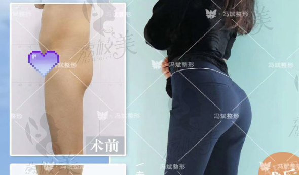 北京东方和谐冯斌医生做的腰腹吸脂＋脂肪填充身材太棒了