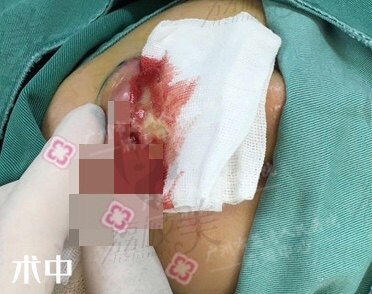 亲身经历在广州荔湾人民医院面部取奥美定，术后没有留疤