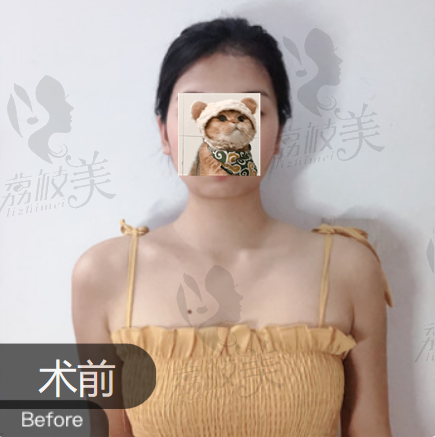 手术前