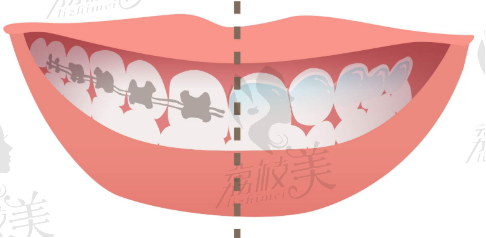 做牙齿矫正选择哪种牙套性价比高？看看牙套种类科普